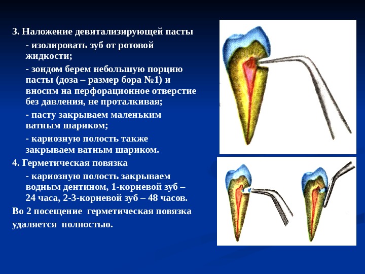 3. Наложение девитализирующей пасты - изолировать зуб от ротовой жидкости; - зондом берем небольшую порцию пасты