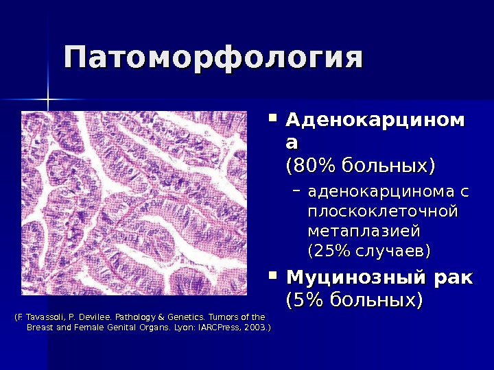 Патоморфология Аденокарцином аа (80 больных) – аденокарцинома с плоскоклеточной метаплазией (25 случаев) Муцинозный рак (5 больных)