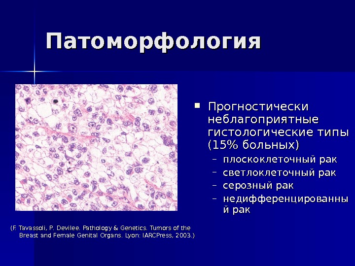 Патоморфология Прогностически неблагоприятные гистологические типы (15 больных) – плоскоклеточный рак – светлоклеточный рак – серозный рак