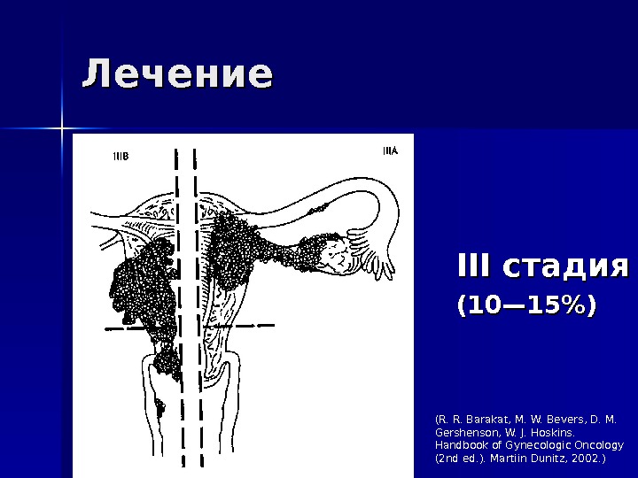 Лечение III стадия (( 10— 15) (R. R. Barakat, M. W. Bevers, D. M.  Gershenson,