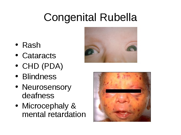 Congenital Rubella • Rash • Cataracts • CHD (PDA) • Blindness • Neurosensory deafness • Microcephaly