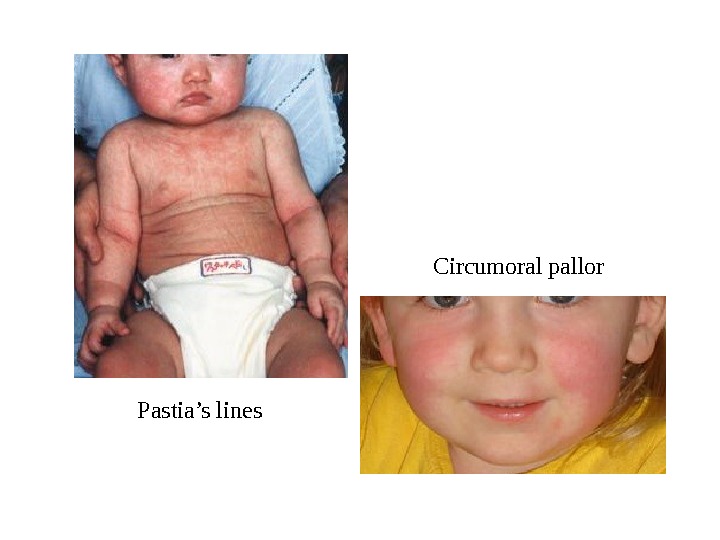 Pastia’s lines Circumoral pallor 