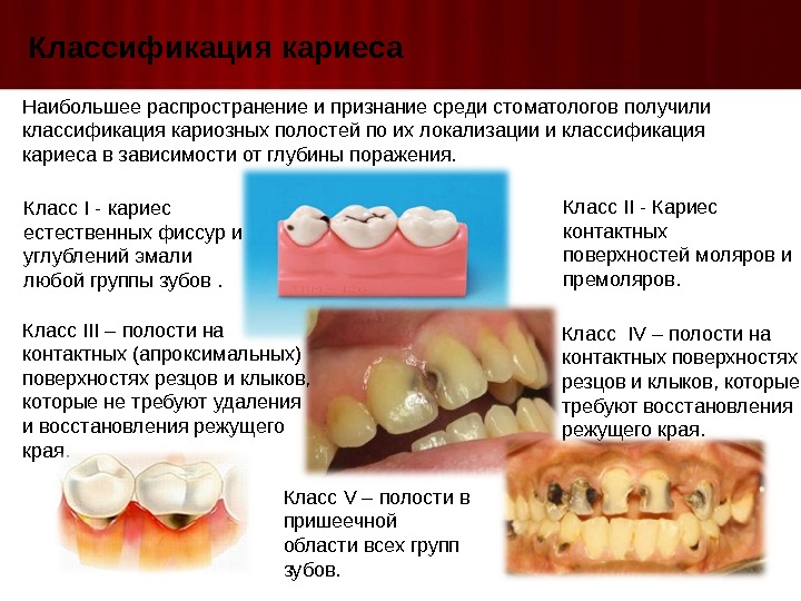 Классификация кариеса Наибольшее распространение и признание среди стоматологов получили классификация кариозных полостей по их локализации и