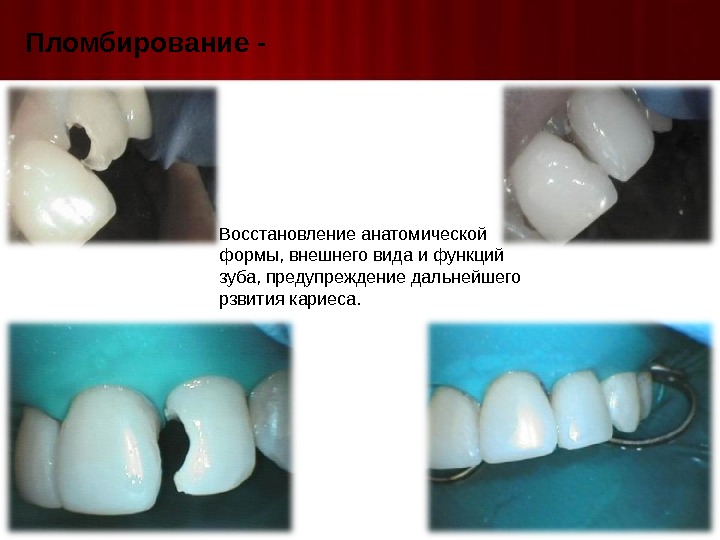 Пломбирование - Восстановление анатомической формы, внешнего вида и функций зуба, предупреждение дальнейшего рзвития кариеса. 