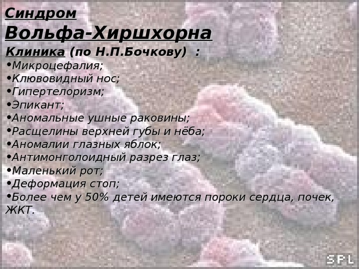   Синдром Вольфа-Хиршхорна Клиника (по Н. П. Бочкову) :  • Микроцефалия;  • Клювовидный