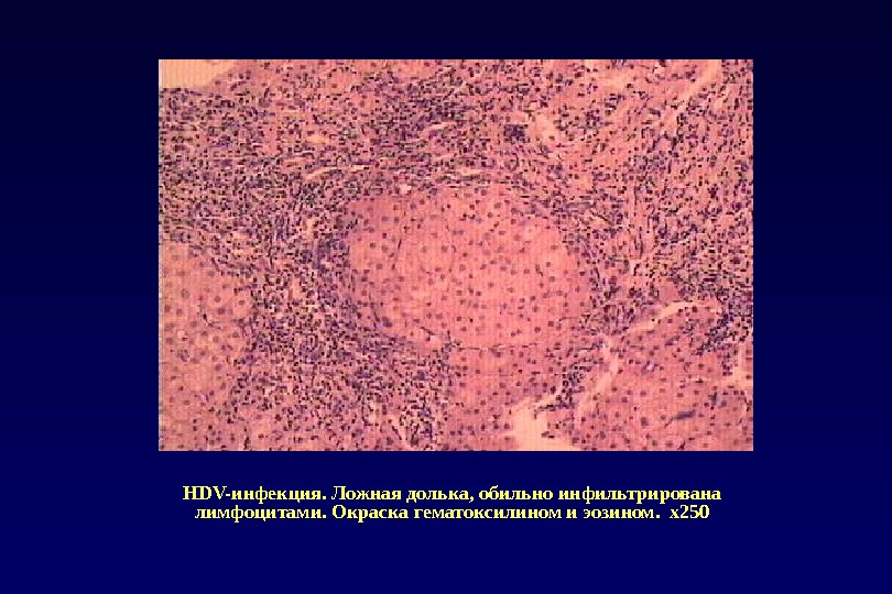 HDV-инфекция. Ложная долька, обильно инфильтрирована лимфоцитами. Окраска гематоксилином и эозином.  х250 