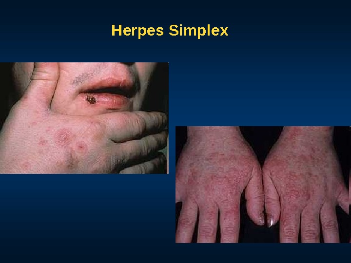 Herpes Simplex 