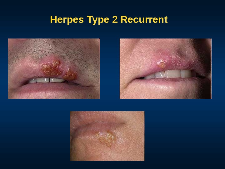 Herpes Type 2 Recurrent 