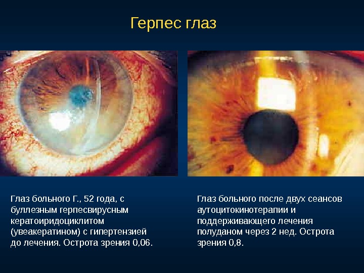 Глаз больного Г. , 52 года, с буллезным герпесвирусным кератоиридоциклитом (увеакератином) с гипертензией до лечения. Острота
