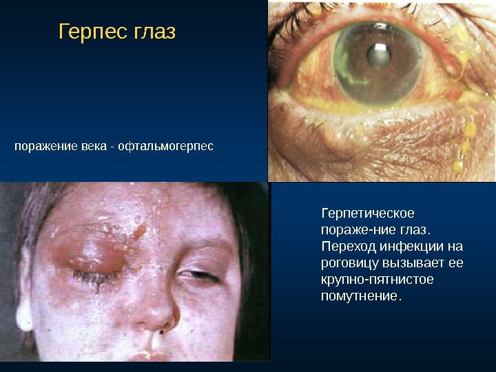 Герпес глаз поражение века - офтальмогерпес Герпетическое пораже-ние глаз.  Переход инфекции на роговицу вызывает ее