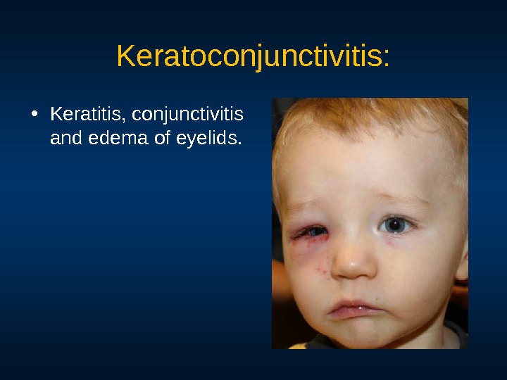 Keratoconjunctivitis:  • Keratitis, conjunctivitis and edema of нelids. 