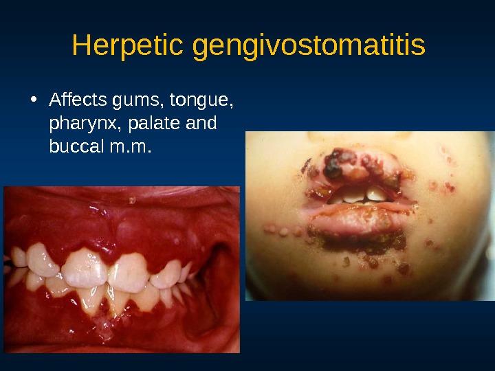 Herpetic gengivostomatitis • Affects gums, tongue,  pharynx, palate and buccal m. m. 