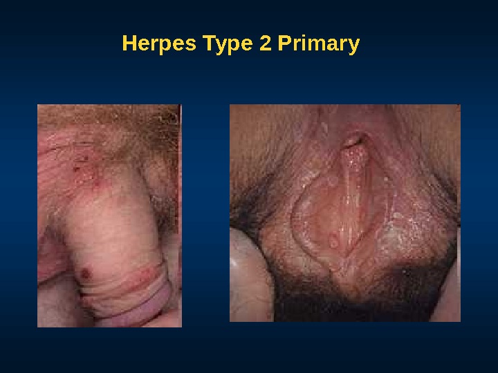 Herpes Type 2 Primary 