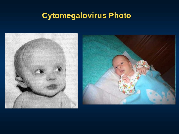 Cytomegalovirus Photo 
