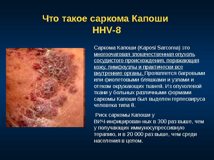 Что такое саркома Капоши  HHV -8 Саркома Капоши (Kaposi Sarcoma) это многоочаговая злокачественная опухоль сосудистого
