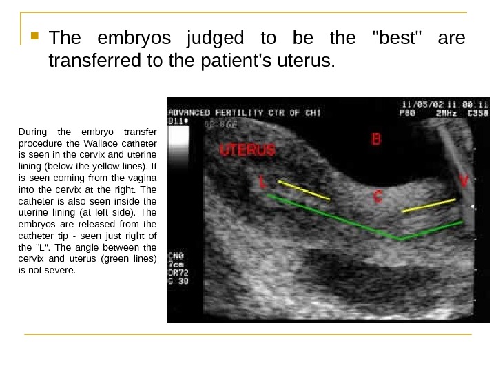  The embryos judged to be the best are transferred to the patient's uterus.  During