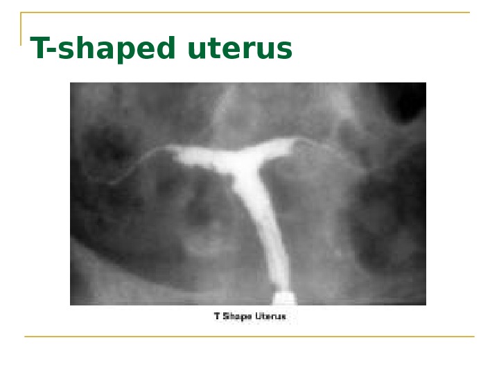 T-shaped uterus 