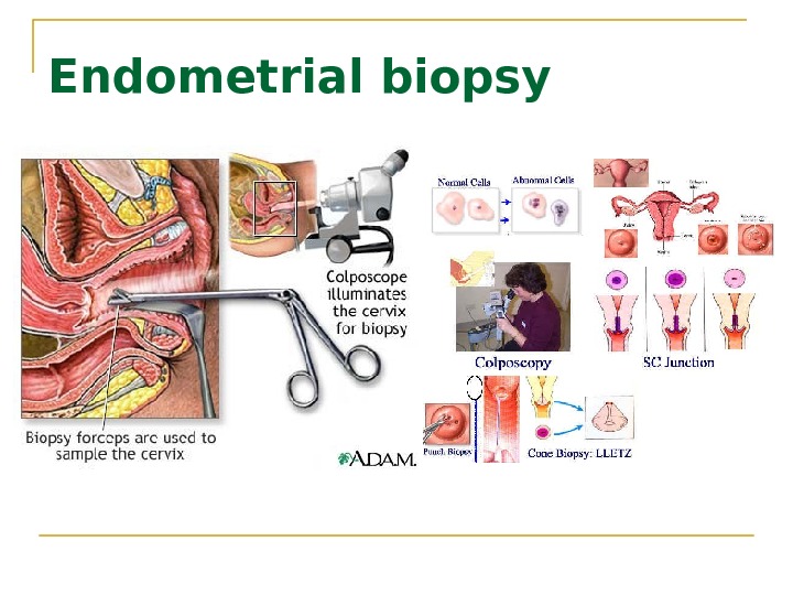 Endometrial biopsy 