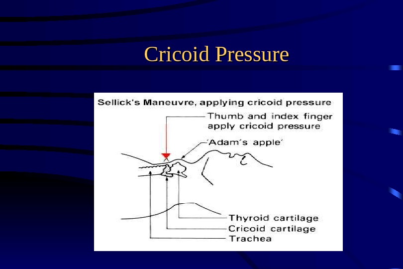 Cricoid Pressure 