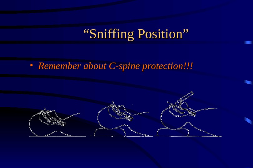 ““ Sniffing Position” • Remember about C-spine protection!!! 