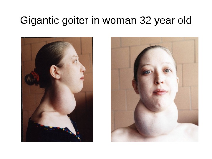Gigantic goiter in woman 32 year old 