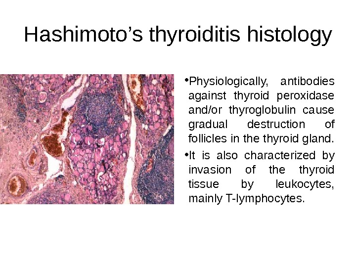 Hashimoto’s thyroiditis histology • Physiologically,  antibodies against thyroid peroxidase and/or thyroglobulin cause gradual destruction of