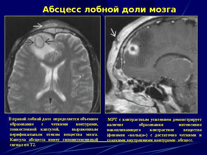  Абсцесс лобной доли мозга    МРТ с контрастным усилением демонстрирует наличие образования интенсивно