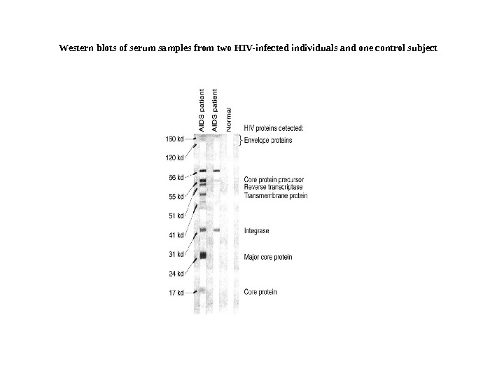   Western blots of serum samples from two HIV-infected individuals and one control subject 