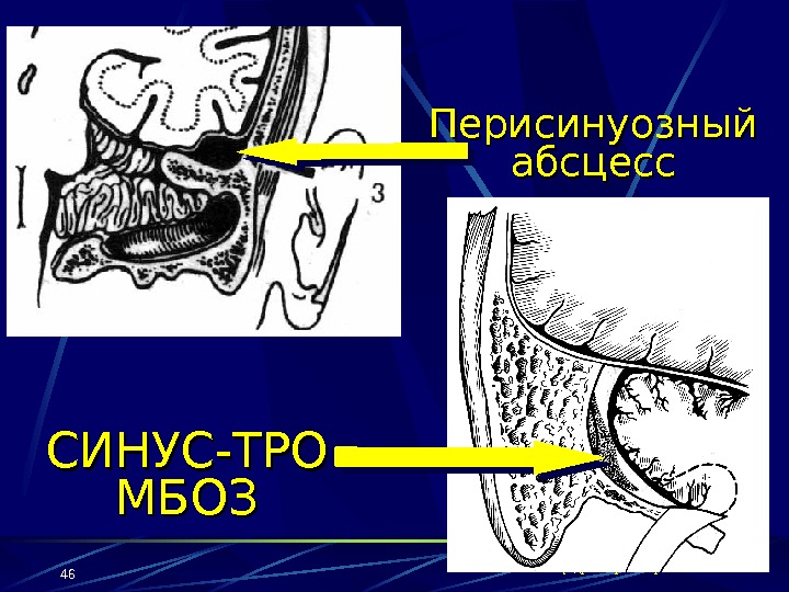 кафедра оториноларингологии СГМУ 46 Перисинуозный абсцесс СИНУС-ТРО МБОЗ 
