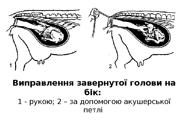 Виправлення завернутої голови на бік:  1 - рукою; 2 – за допомогою акушерської петлі 
