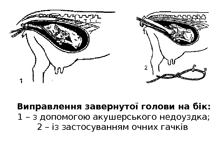 Виправлення завернутої голови на бік:  1 – з допомогою акушерського недоуздка;  2 – із