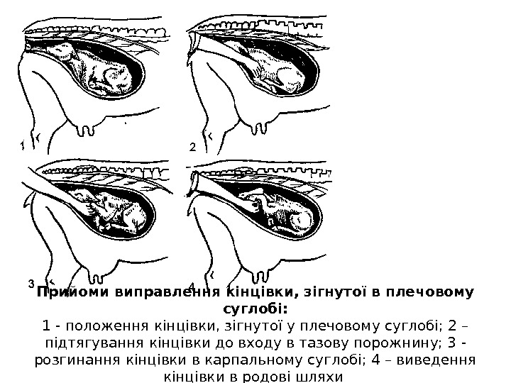 Прийоми виправлення кінцівки, зігнутої в плечовому суглобі: 1 - положення кінцівки, зігнутої у плечовому суглобі; 2