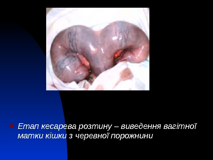  Етап кесарева розтину – виведення вагітної матки кішки з черевної порожнини 