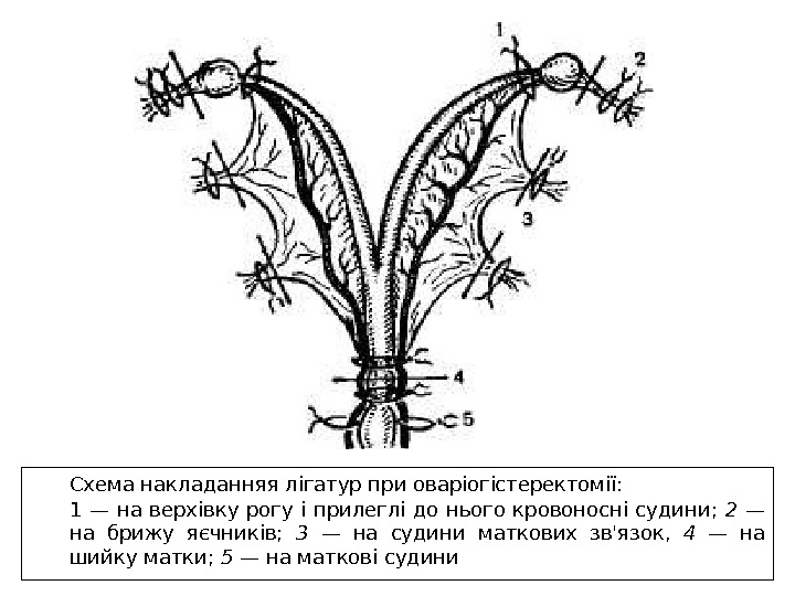 Схема накладанняя лігатур при оваріогістеректомії: 1 — на верхівку рогу і прилеглі до нього кровоносні судини;