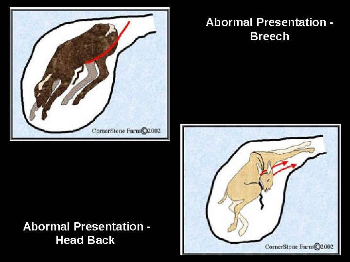 Abormal Presentation - Breech Abormal Presentation - Head Back 