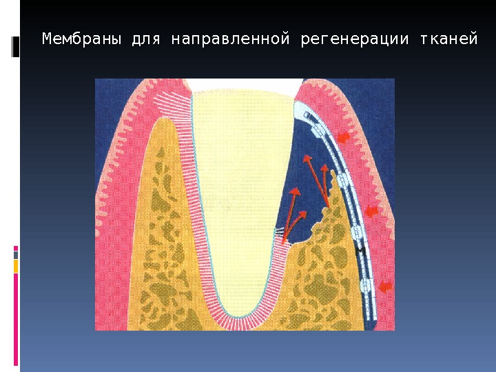 Мембраны для направленной регенерации тканей 