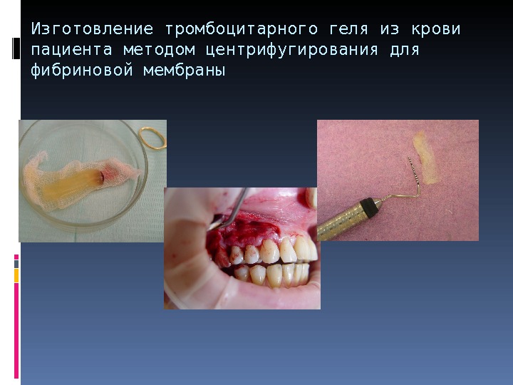 Изготовление тромбоцитарного геля из крови пациента методом центрифугирования для фибриновой мембраны 