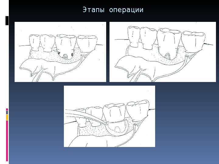 Этапы операции 