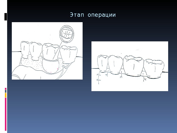 Этап операции 