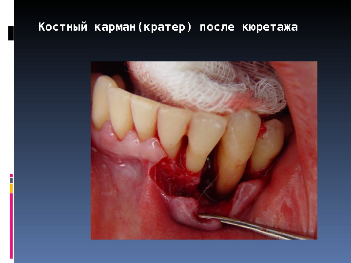 Костный карман(кратер) после кюретажа  