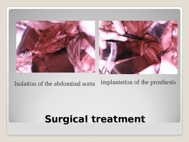 Surgical treatment. Isolation of the abdominal aorta implantation of the prosthesis 