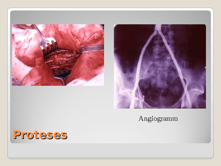 Proteses Angiogramm 