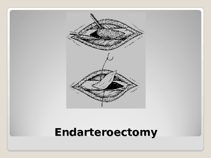 Endarteroectomy 