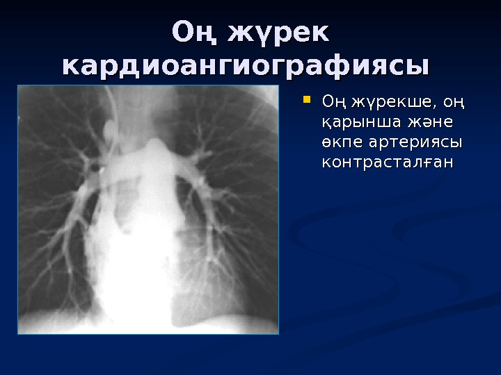 Оң жүрек кардиоангиографиясы  Оң жүрекше, оң қарынша және өкпе артериясы контрасталған 