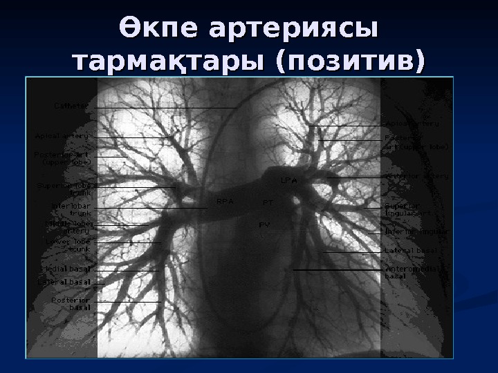 Өкпе артериясы тармақтары (позитив) 