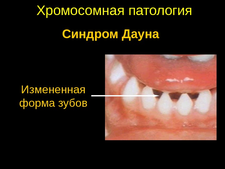 Хромосомная патология Измененная форма зубов Синдром Дауна 