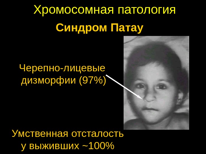 Хромосомная патология Синдром Патау Умственная отсталость у выживших ~ 100Черепно-лицевые дизморфии (97) 