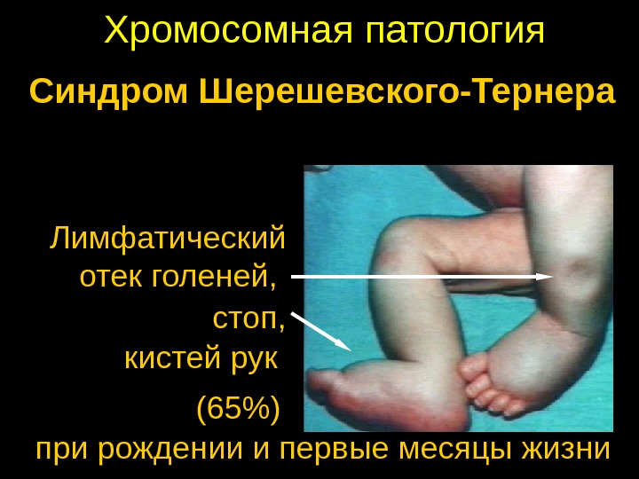 Хромосомная патология Синдром Шерешевского-Тернера Лимфатический отек голеней,  c топ , кистей рук (65) при рождении