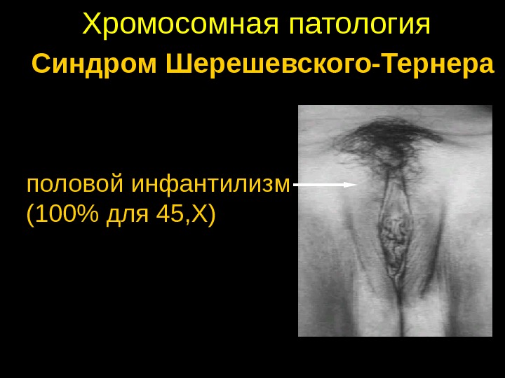 Хромосомная патология Синдром Шерешевского-Тернера половой инфантилизм (100 для 45, Х) 