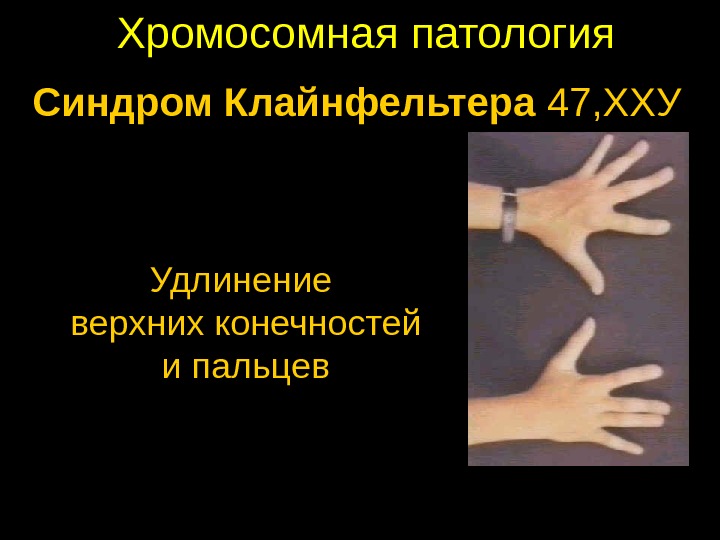 Хромосомная патология Синдром Клайнфельтера 47, ХХУ Удлинение верхних конечностей и пальцев 